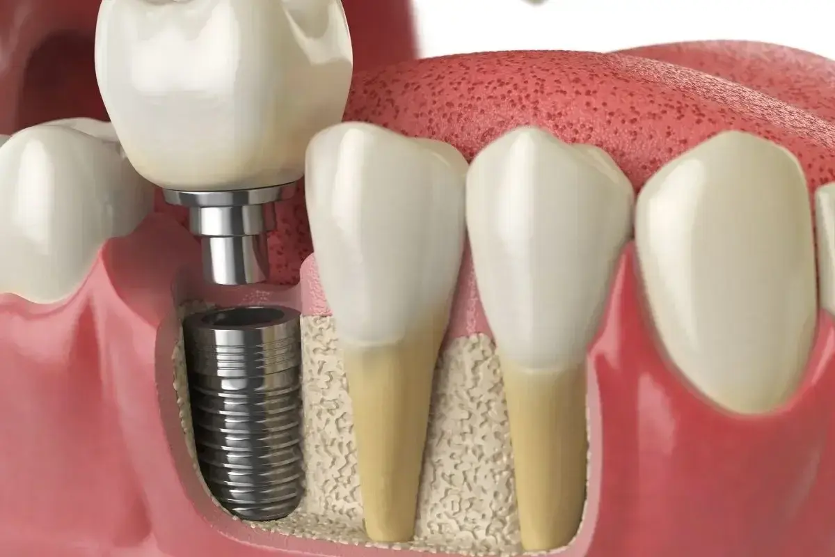 Dental implant cross-section showing titanium screw in jawbone with crown restoration next to natural teeth.