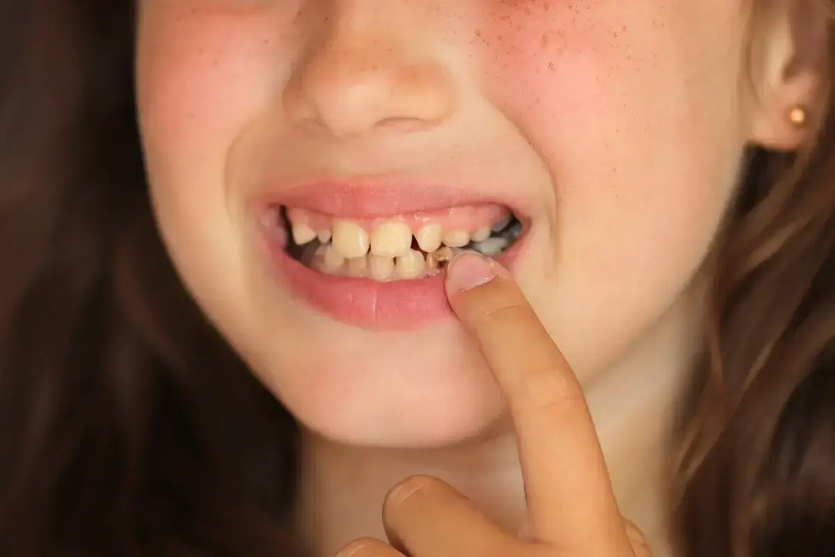 Child pointing to gap between front teeth showing tooth decay and dental concerns.